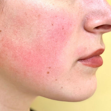 Rosacea – mi az és hogyan kezeld otthon?