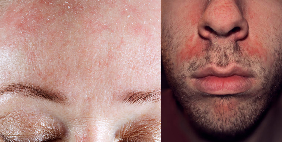 Diéta menü a seborrhea (seborrheás dermatitis) a fejbőr és az arc